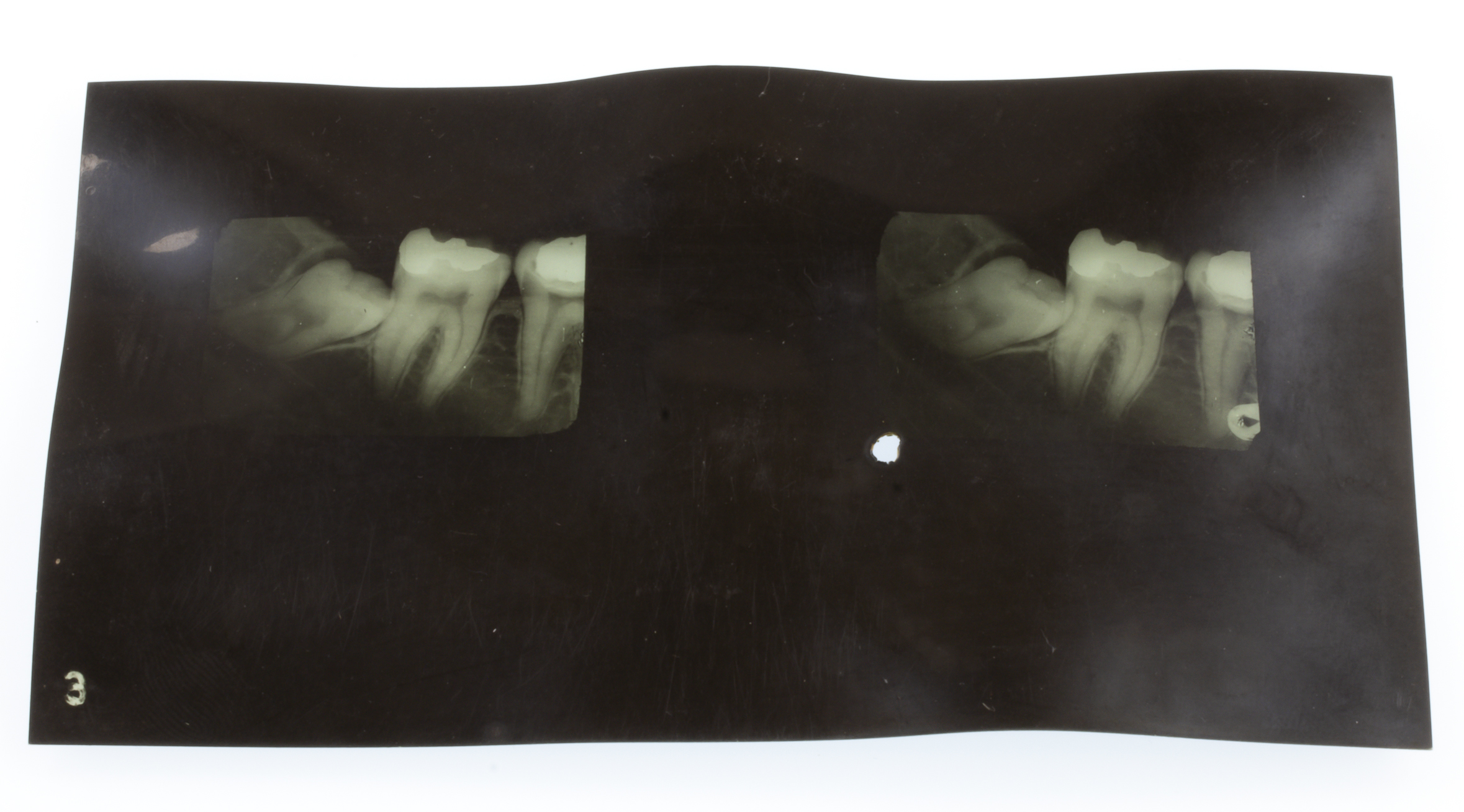 Left and right images for a stereo dental x-ray on a small sheet of x-ray film